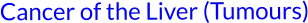Cancer of the Liver (Tumours)